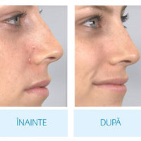 Încărcați imaginea în vizualizatorul Galeriei, Aspirator facial, pentru un ten curat
